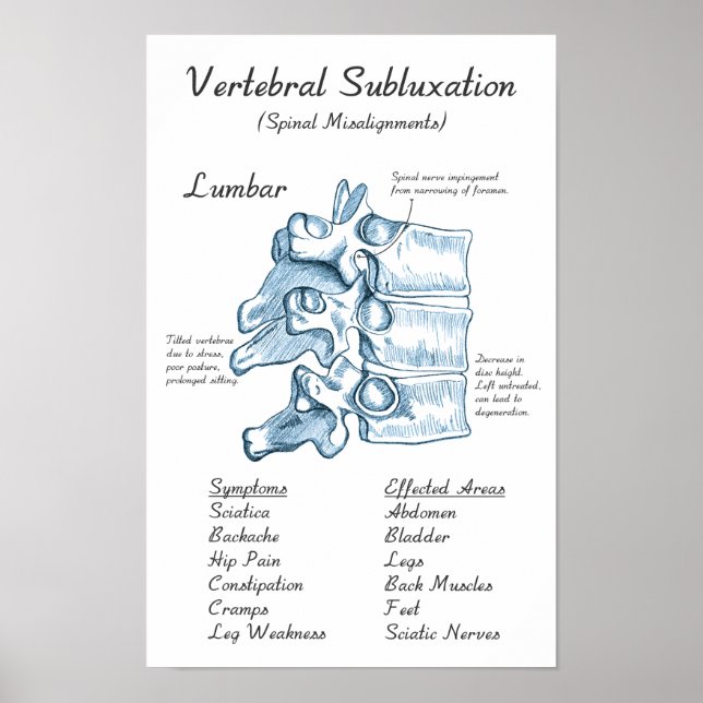 Poster av "Lumbar Subluxation Chiropraktic Art" (Framsidan)