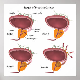 Poster av prostatacancer