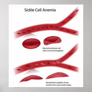 Poster av sicklecellanemi