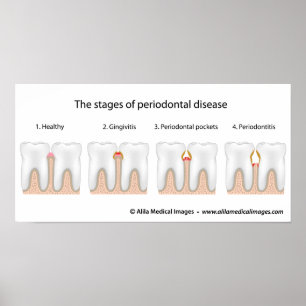 Poster av tandPeriodontal sjukdom