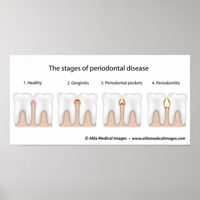 Poster av tandPeriodontal sjukdom (Framsidan)
