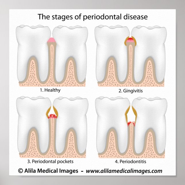Poster av tandPeriodontal sjukdom (Framsidan)
