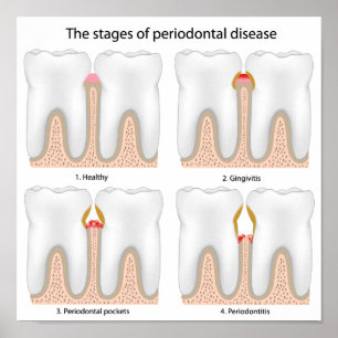 Poster av tandPeriodontal sjukdom