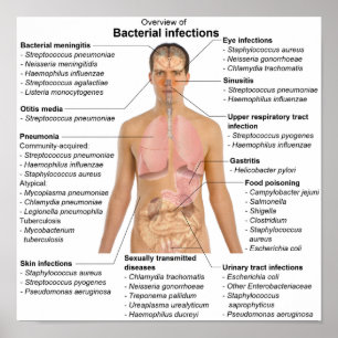 Poster diagram över bakterieinfektioner hos männis