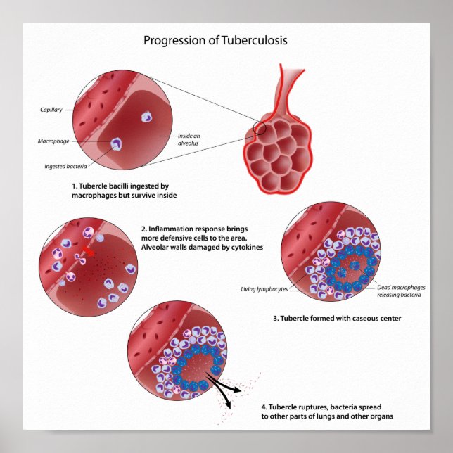 Progressionen av pulmonell tuberkulos Poster (Framsidan)