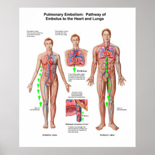 Pulmonär embolism, Embolusvägg Poster