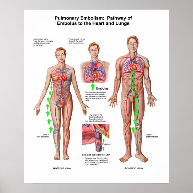 Pulmonär embolism, Embolusvägg Poster (Framsidan)