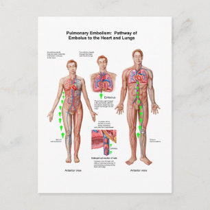 Pulmonär embolism, Embolusvägg Vykort