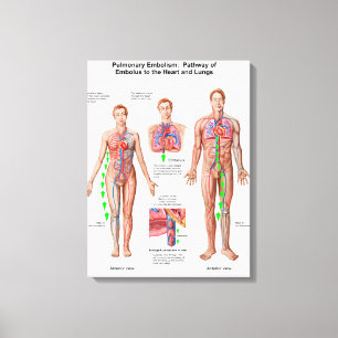 Pulmonary blodpropp, bana av embolusen canvastryck