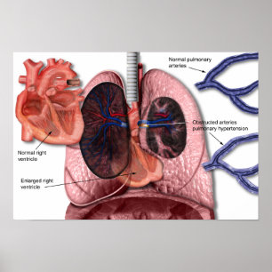 Pulmonary högt blodtryckaffisch poster