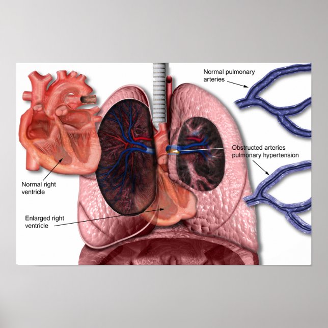 Pulmonell hypertension poster (Framsidan)