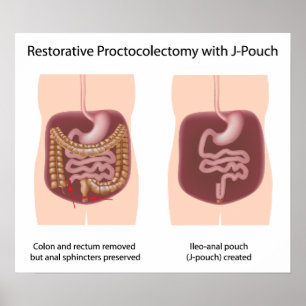 Reparativ proctokolektomi med j-pouch poster