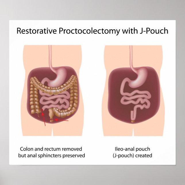 Reparativ proctokolektomi med j-pouch poster (Framsidan)