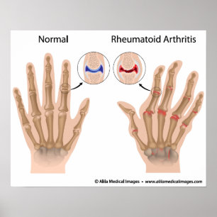 Reumatoid artrit i finger leder, diagram. poster