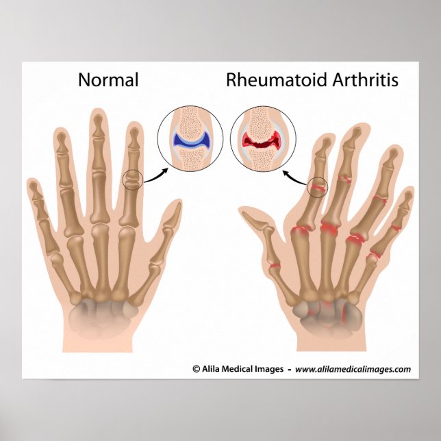 Reumatoid artrit i finger leder, diagram. poster (Framsidan)