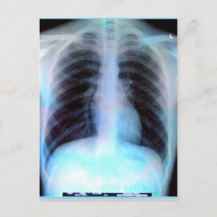 Ribcage Xray Skeleton Vykort