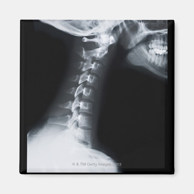 Röntgen på nacke, inklusive nedre käke magnet (Framsidan)