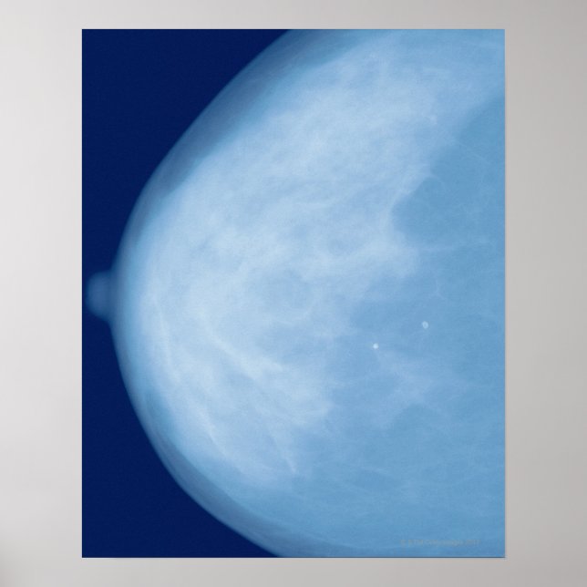 röntgenbild av kvinnligt bröst, biseende poster (Framsidan)