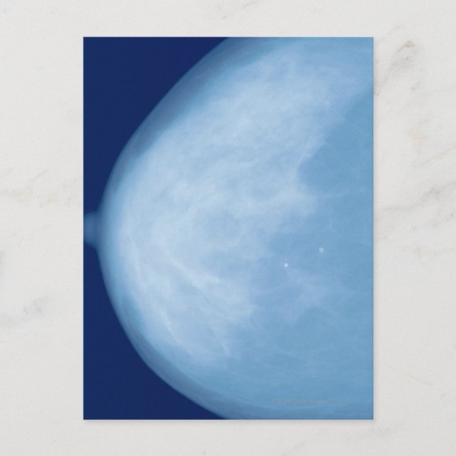 röntgenbild av kvinnligt bröst, biseende vykort (Framsida)