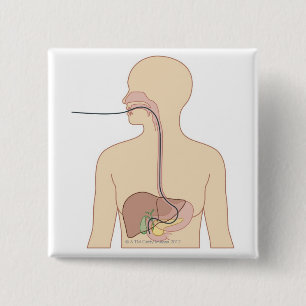 Rutt av endoscopen knapp