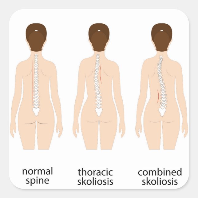 Ryggdeformitet Fyrkantigt Klistermärke (Framsida)