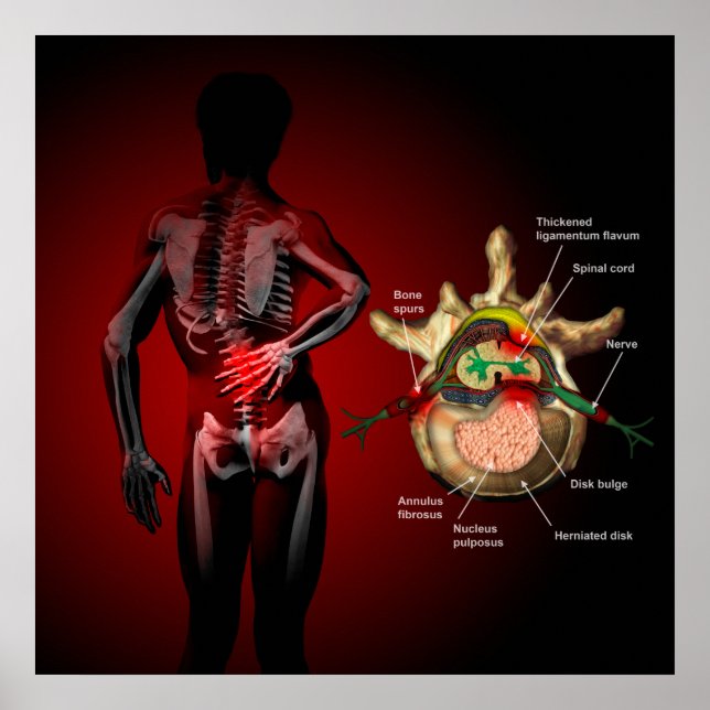 Ryggsmärta Poster (Framsidan)