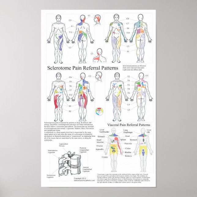 Sclerotome Visceral Pain Referral Diagram Poster (Framsidan)
