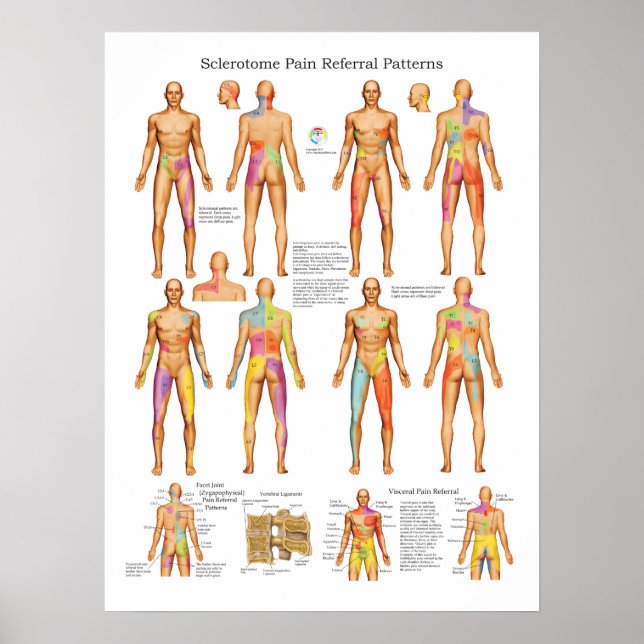 Sclerotome Visceral Pain Referral Poster (Framsidan)