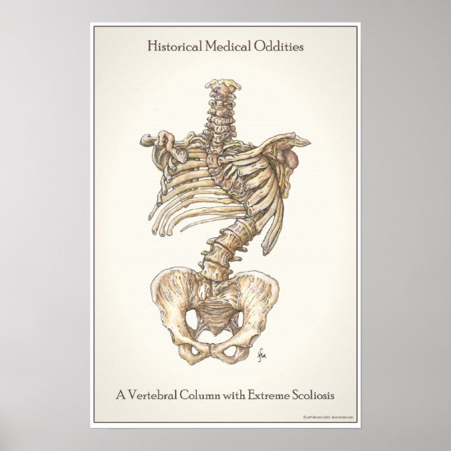 Scoliosis Spine Poster (Framsidan)