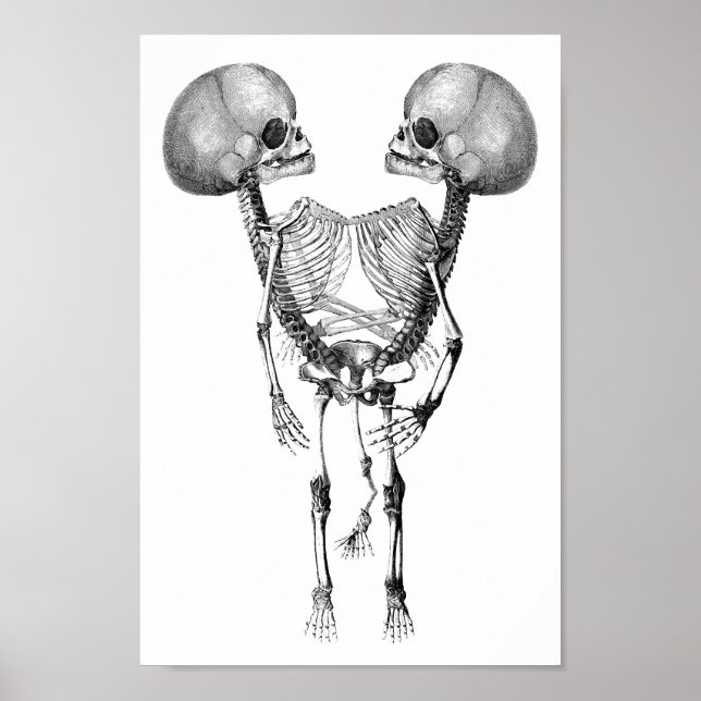 Siamesisk konförening av Twillingar Anatomy Skelet Poster (Framsidan)