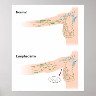 Sjukdomsdiagram för lymfom arm poster