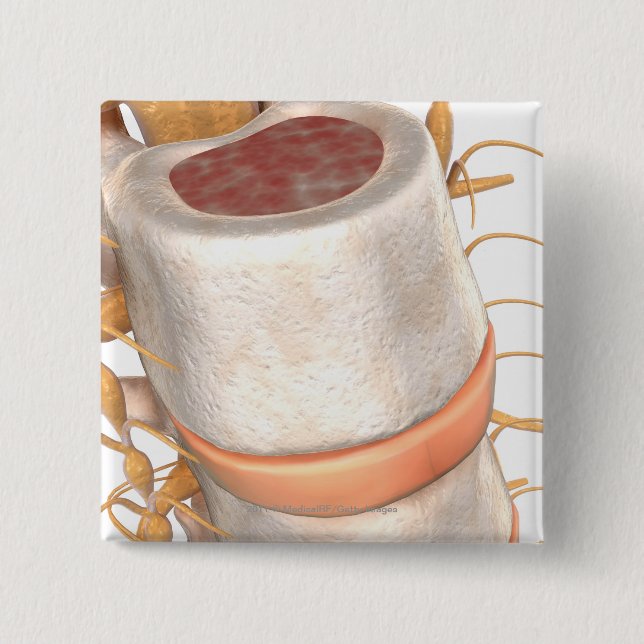 Slut upp av en invertebral diskett i ryggen knapp (Framsida)