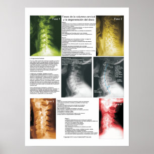 Spanjoren arrangerar gradvis den Cervical Poster