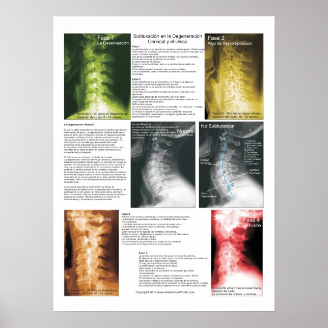 Spansk subluxation av cervikal spinaldegenerering poster (Framsidan)