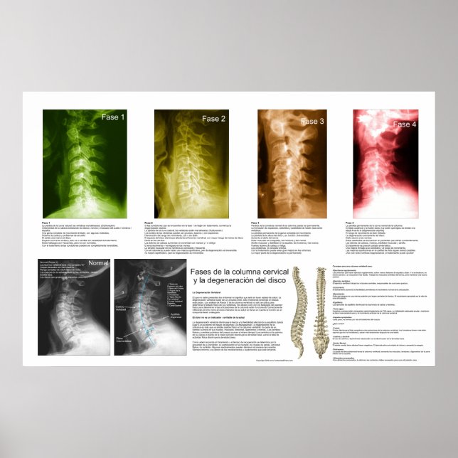 Spanska faser Cervical Spinal Degeneration Poster (Framsidan)