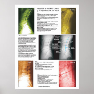 Spanska faser - Lumbar spinaldegenerering Poster