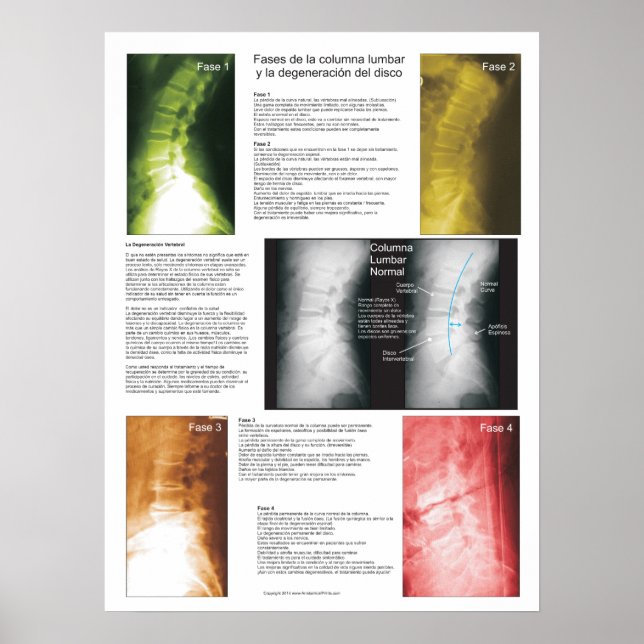 Spanska faser - Lumbar spinaldegenerering Poster (Framsidan)
