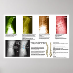 Spanska faser - Lumbar spinaldegenerering Poster