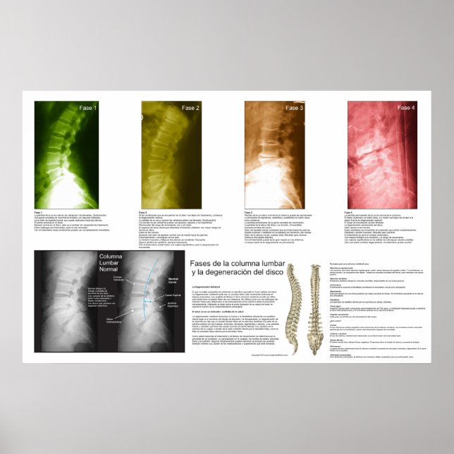Spanska faser - Lumbar spinaldegenerering Poster (Framsidan)