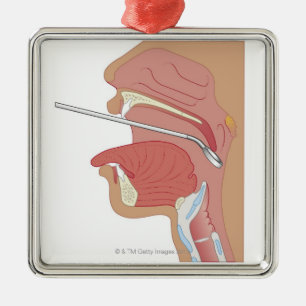 SpegelLaryngoscopy Julgransprydnad Metall