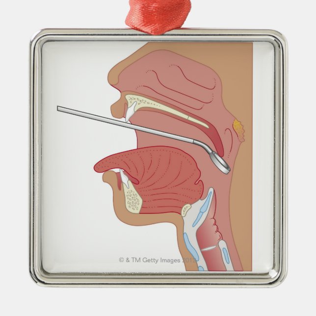 SpegelLaryngoscopy Julgransprydnad Metall (Framsidan)