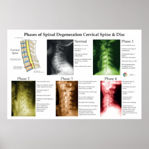 Spinal degeneration cervikal ryggrad kiropraktik poster