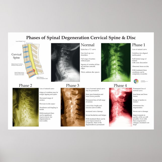 Spinal degeneration cervikal ryggrad kiropraktik poster (Framsidan)