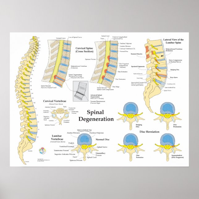 Spinal Degeneration Disk Herniation Poster (Framsidan)