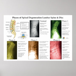 Spinal degeneration ländrygg kiropraktik poster