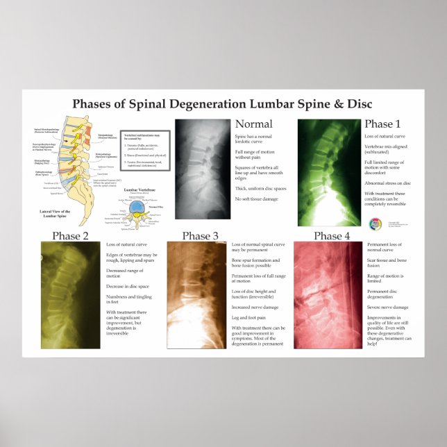 Spinal degeneration ländrygg kiropraktik poster (Framsidan)