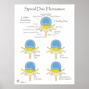 Spinal Disk Herniation Poster Medicinsk Poster