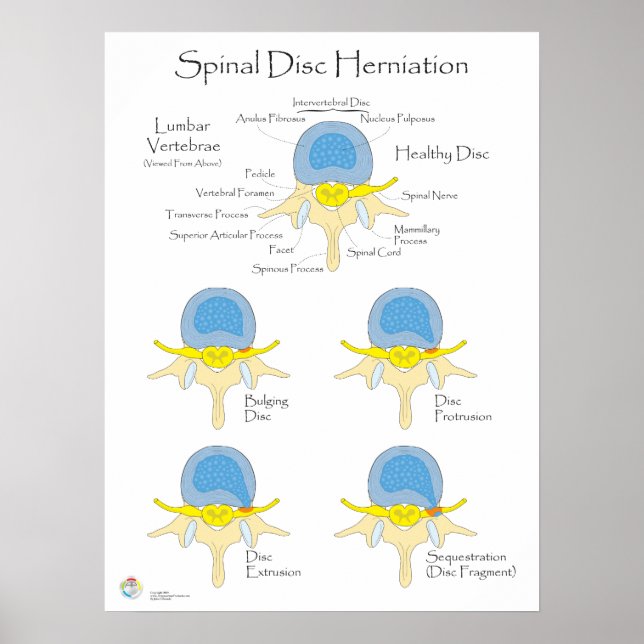 Spinal Disk Herniation Poster Medicinsk Poster (Framsidan)