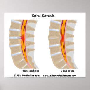 Spinal Stenos, medicinska teckning. Poster