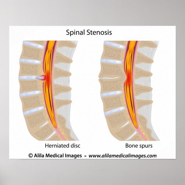 Spinal Stenos, medicinska teckning. Poster (Framsidan)